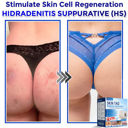💞☘️Celsiora® Multi-Functional Microneedle Hydrocolloid Patch Roll | Targets Skin Tags, Warts & Stubborn Blemishes
