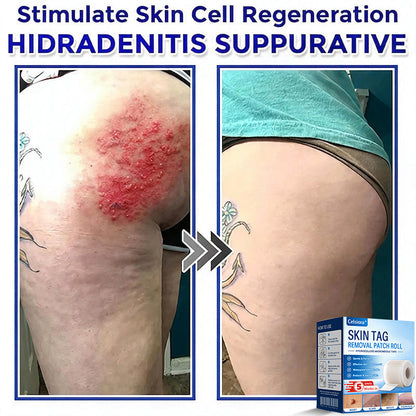 💞☘️Celsiora® Multi-Functional Microneedle Hydrocolloid Patch Roll | Targets Skin Tags, Warts & Stubborn Blemishes