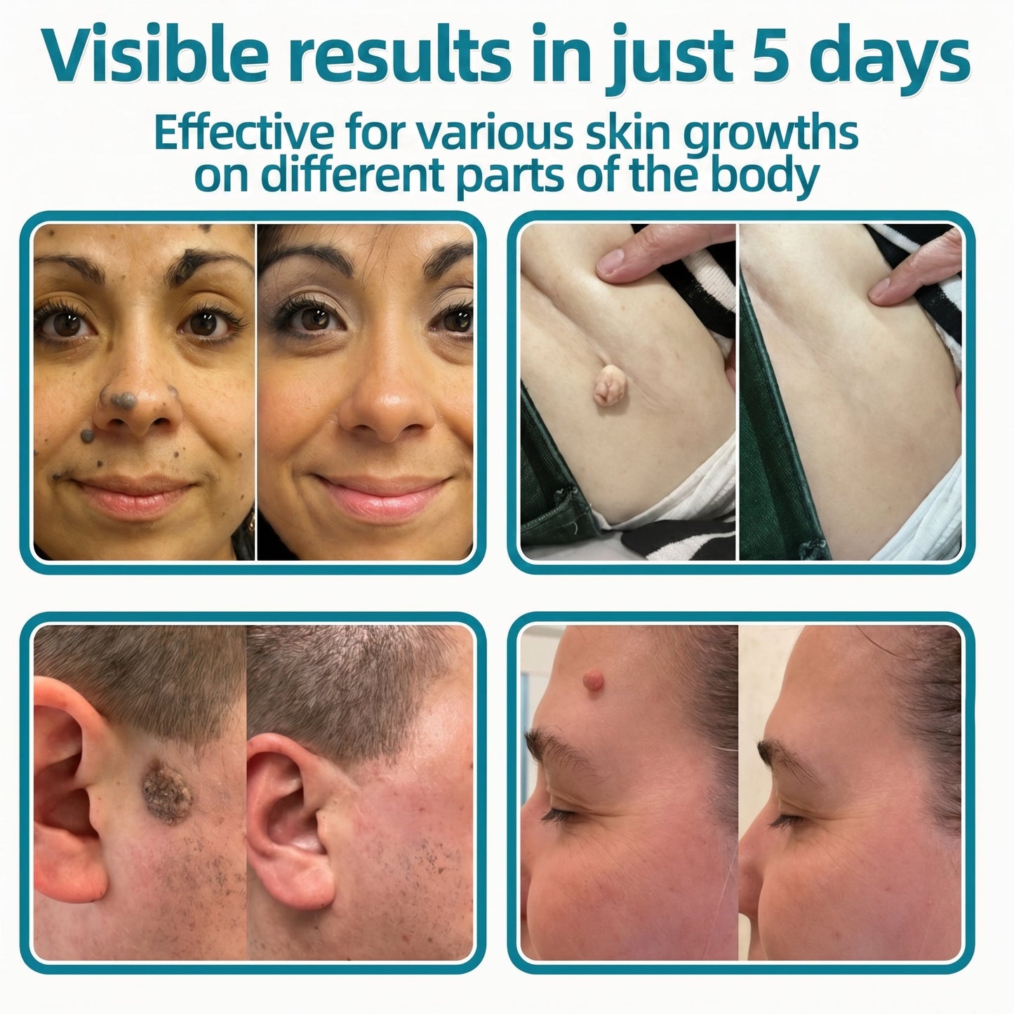 ✅Trilumia®2-in-1 Microneedle & Hydrocolloid Patch💫| Removes Raised Moles, Acne, Flat Warts & Skin Tags | Helps Improve Wrinkles, Scars & Blemishes | Invisible Patches for Face & Body