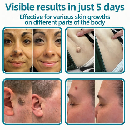 ✅Trilumia®2-in-1 Microneedle & Hydrocolloid Patch💫| Removes Raised Moles, Acne, Flat Warts & Skin Tags | Helps Improve Wrinkles, Scars & Blemishes | Invisible Patches for Face & Body