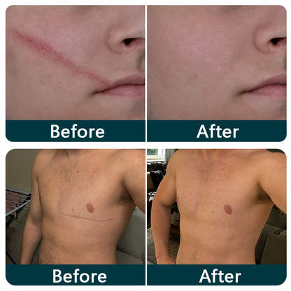 💞👩‍⚕️TRILUMIA® SILICONE SCAR THERAPY ROLL  Help Soften, Flatten & Improve the Appearance of Raised Scars