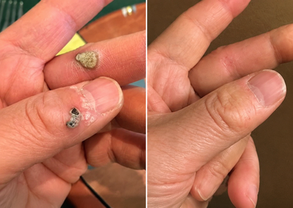 ✅Trilumia®2-in-1 Microneedle & Hydrocolloid Patch💫| Removes Raised Moles, Acne, Flat Warts & Skin Tags | Helps Improve Wrinkles, Scars & Blemishes | Invisible Patches for Face & Body