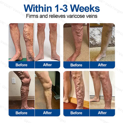 💞🪐GFOUK® VeinTarget Microneedle Patch⚡Instant Relief, Long-Term Results