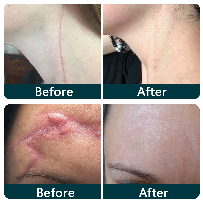 💞👩‍⚕️TRILUMIA® SILICONE SCAR THERAPY ROLL  Help Soften, Flatten & Improve the Appearance of Raised Scars