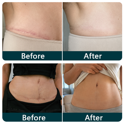 💞👩‍⚕️TRILUMIA® SILICONE SCAR THERAPY ROLL  Help Soften, Flatten & Improve the Appearance of Raised Scars